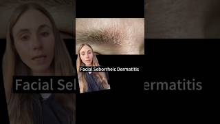 Oily Flaky Skin On The Face dermatologist [upl. by Maroj99]