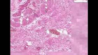 Histopathology Skin  Dry gangrene [upl. by Naitsabes]