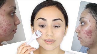 Derma Roller for Acne Scars  How I Healed My Acne Scars [upl. by Aw]