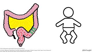 Hirschsprungs Disease [upl. by Cohe]