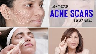 How to Prevent and Treat Acne Scars [upl. by Olia477]