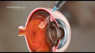 Intravitreal Injection Animation HD [upl. by Anrim]