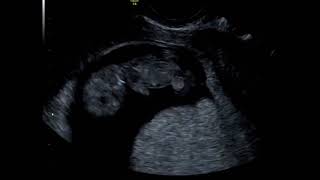 What Can You See At A 10 Week Baby Scan [upl. by Nitniuq]