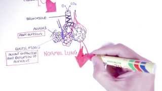 Emphysema  Introduction Types Symptoms Diagnosis [upl. by Crandall460]