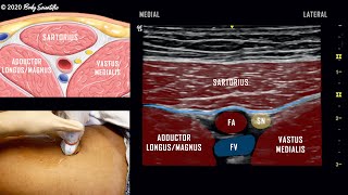 Adductor Canal Block Saphenous Nerve  UltrasoundGuided Demonstration [upl. by Neitsabes]