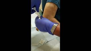 Elbow Bursitis Drainage amp LidocaineSteroid Injection [upl. by Anora251]