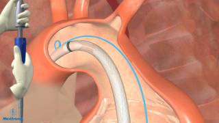 Thoracic Endovascular Aortic Aneurysm Repair in Dallas [upl. by Whittemore]