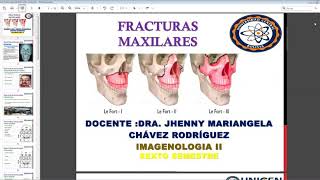 Fracturas Maxilares Clasificación Lefort [upl. by Cassil]