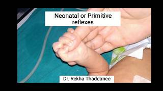 Neonatal Reflex  Palmar Grasp Reflex  Primitive Reflex  Pediatrics [upl. by Anetsirhc]