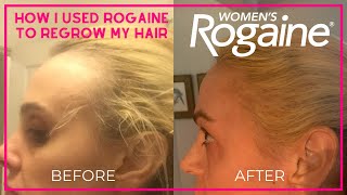 Rogaine for Women Before and After [upl. by Deryl]