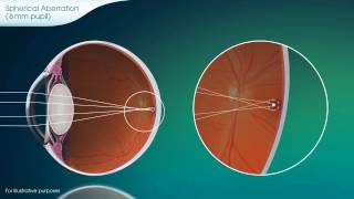 Spherical Aberration Explained  PureVision2 [upl. by Arahc546]