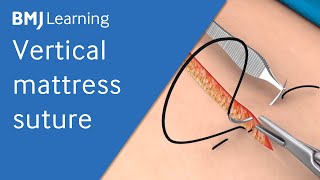 Vertical Mattress Suture  BMJ Learning [upl. by Fabrienne]