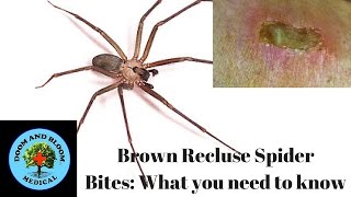 Brown Recluse Spider Bites What you need to know [upl. by Bette-Ann]