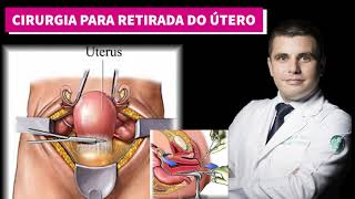 Histerectomia  A cirurgia para retirada do útero [upl. by Theo]