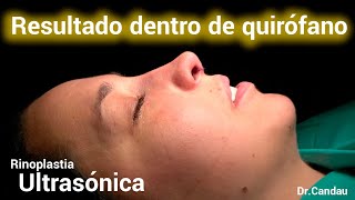 Rinoplastia Ultrasónica Experiencia de nuestra paciente [upl. by Dahij]