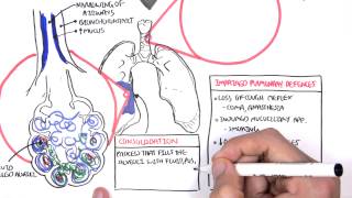 PART I  Pneumonia Overview Lobar and Bronchopneumonia [upl. by Danuloff]