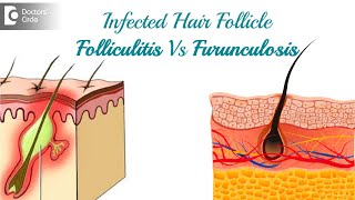 Infected hair follicle What to do Causes Location amp TreatmentDr Rasya Dixit  Doctors Circle [upl. by Mutat220]