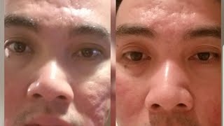 Deep acne scar before and after using Dermapen [upl. by Nynnahs158]