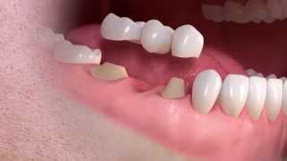 Straumann  Conventional 3unit bridge treatment [upl. by Allit]