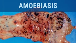 Amoebiasis  Pathology mini tutorial [upl. by Krid127]