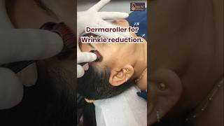 Dermaroller for Wrinkle Reduction [upl. by Anaujd]