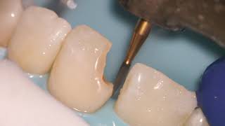 Teeth Bonding  Front tooth filling EXPLAINED [upl. by Yhtamit355]