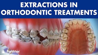 Extractions in Orthodontic Treatment  Is it necessary © [upl. by Assillam]