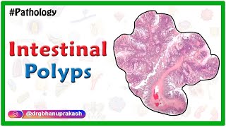 Pathology 521 g Neoplastic polyp tubular adenomatous villous papilloma tubulovillous papillary [upl. by Alain]