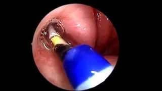 Eustachian Tube Balloon Dilation [upl. by Stanway]