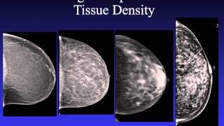 Introduction to Mammography [upl. by Cosma]