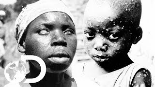 The Eradication Of Smallpox  Invisible Killers [upl. by Yemorej]