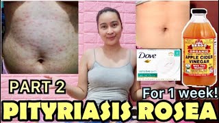 PITYRIASIS ROSEA WHAT’S MY STORY PHILIPPINES [upl. by Domel]