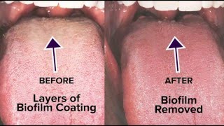 Tongue Rejuvenation The ANSWER to Fixing Chronic Bad Breath amp Halitosis [upl. by Aicrag]