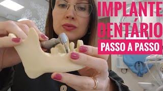 Implante Dentário Passo a Passo l Dra Danielle Sales [upl. by Huan]