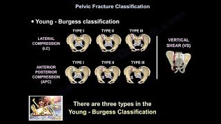 Pelvic Fractures  Everything You Need To Know  Dr Nabil Ebraheim [upl. by Farland]