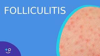 Folliculitis  Daily Dos of Dermatology [upl. by Cassey464]