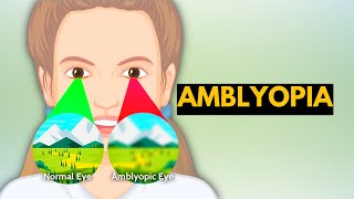 Successful Treatment of Amblyopia  Wow Vision Therapy [upl. by Nelan]