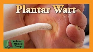 Plantar Wart Treatment  Auburn Medical Group [upl. by Hanikahs]