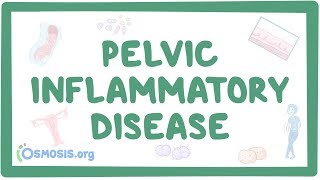 Pelvic inflammatory disease  causes symptoms diagnosis treatment pathology [upl. by Adlesirg]