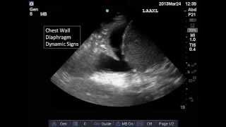 Lung and Pleural Ultrasound Interpretation [upl. by Cas62]