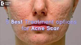 5 Best Treatment options for Acne Scar  Dr Sankeerth Vijayakumar [upl. by Laith]