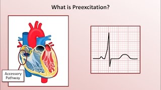 My Heart Condition  WolffParkinsonWhite Syndrome [upl. by Donovan]