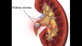 Nephrolithiasis [upl. by Karb]