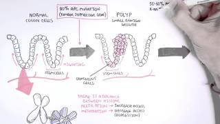 Colon Cancer Carcinogensis [upl. by Ennaylil307]