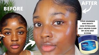 HOW VASELINE HELPED CLEAR MY ACNE AND EZCEMA FASTER  KAISERCOBY [upl. by Meit]