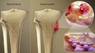 OSTEOMIELITIS [upl. by Einneg680]