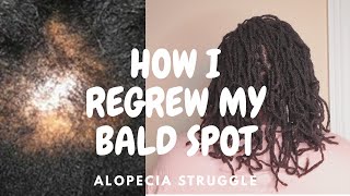 How I regrew my Bald Spot  Alopecia and locs 2023 [upl. by Nitsej798]