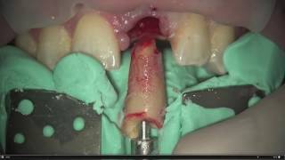 Dental Excellence 17 Root Extraction System [upl. by Viridi]