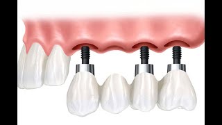 Diş çekimi sonrası implant ve köprü uygulaması [upl. by Still]
