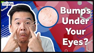 Milia Syringoma Skin Tag amp F Spots Explained [upl. by Ennovyahs]